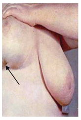 Рак молочной железы синдром площадки